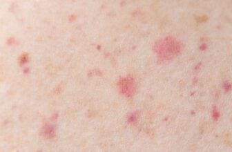 Chigger Bite: Pictures, Treatments and Prevention